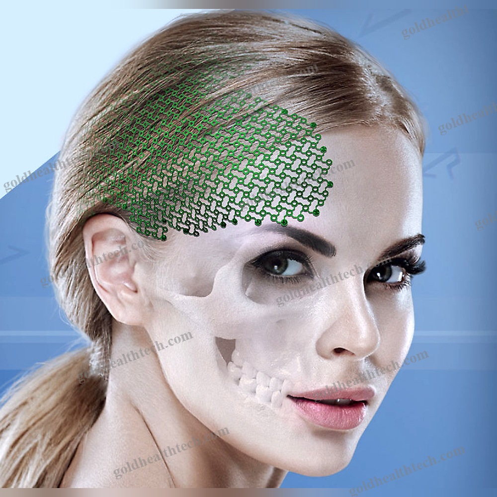 Non-Absorbable Cranial Fixation System
