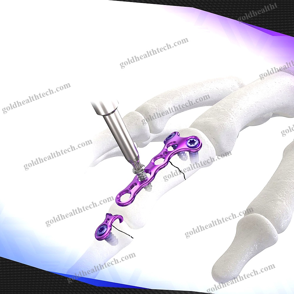 Hand Phalange Compression Plate