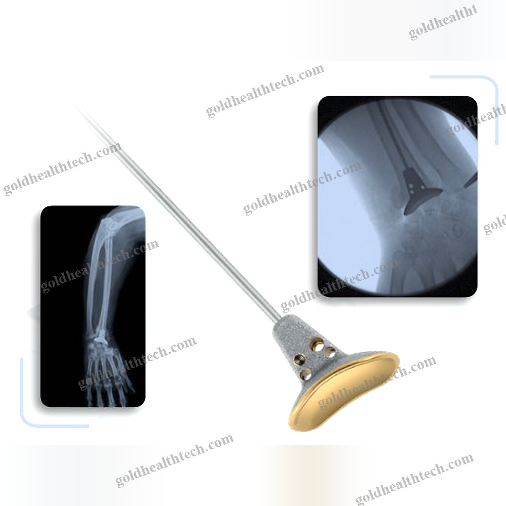 Cementless Distal Radius Prosthesis