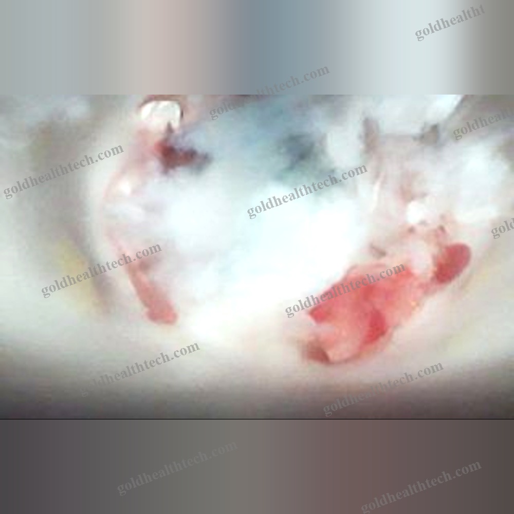 High-Definition Video Spinalscope