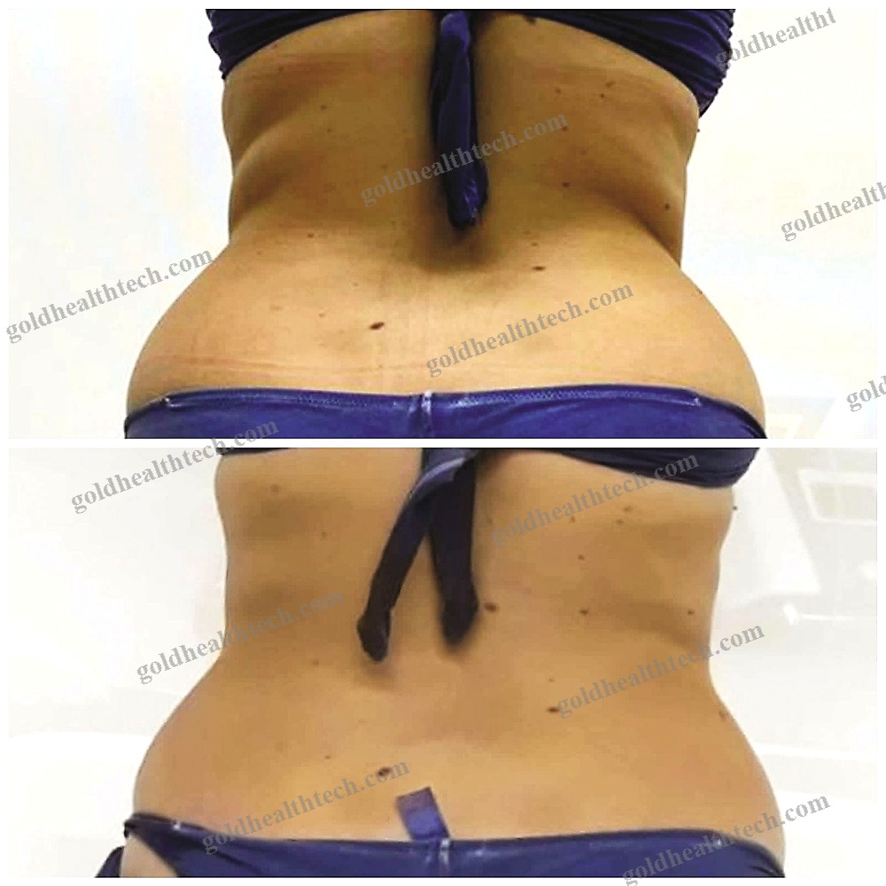 Rf Skin Rejuvenation Unit