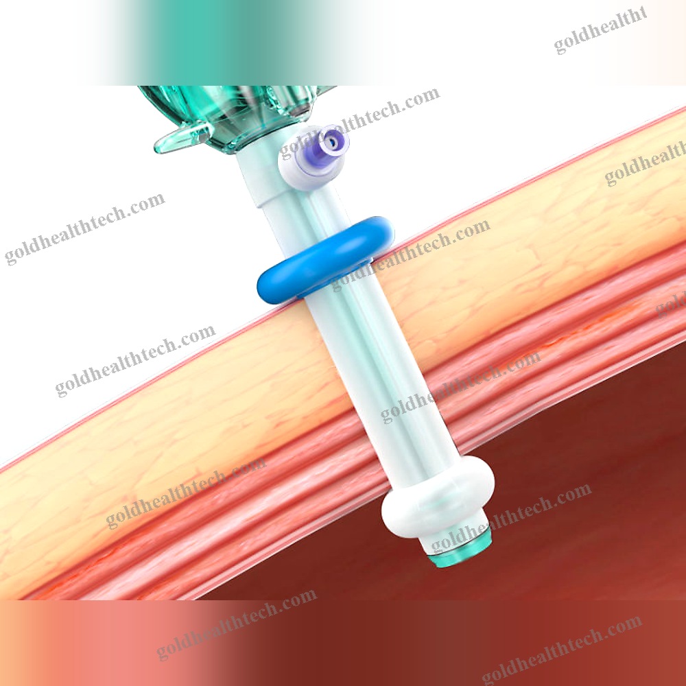 Laparoscopic Trocar