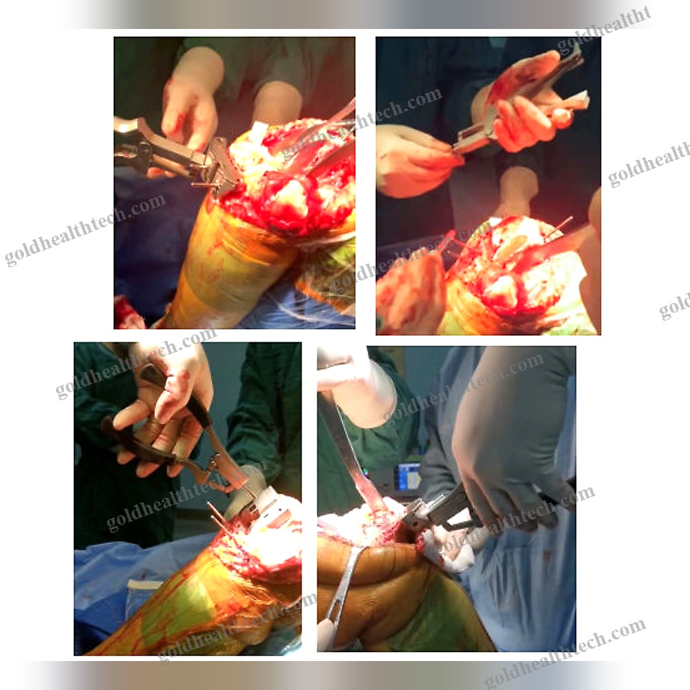 Surgical Staple Extractor