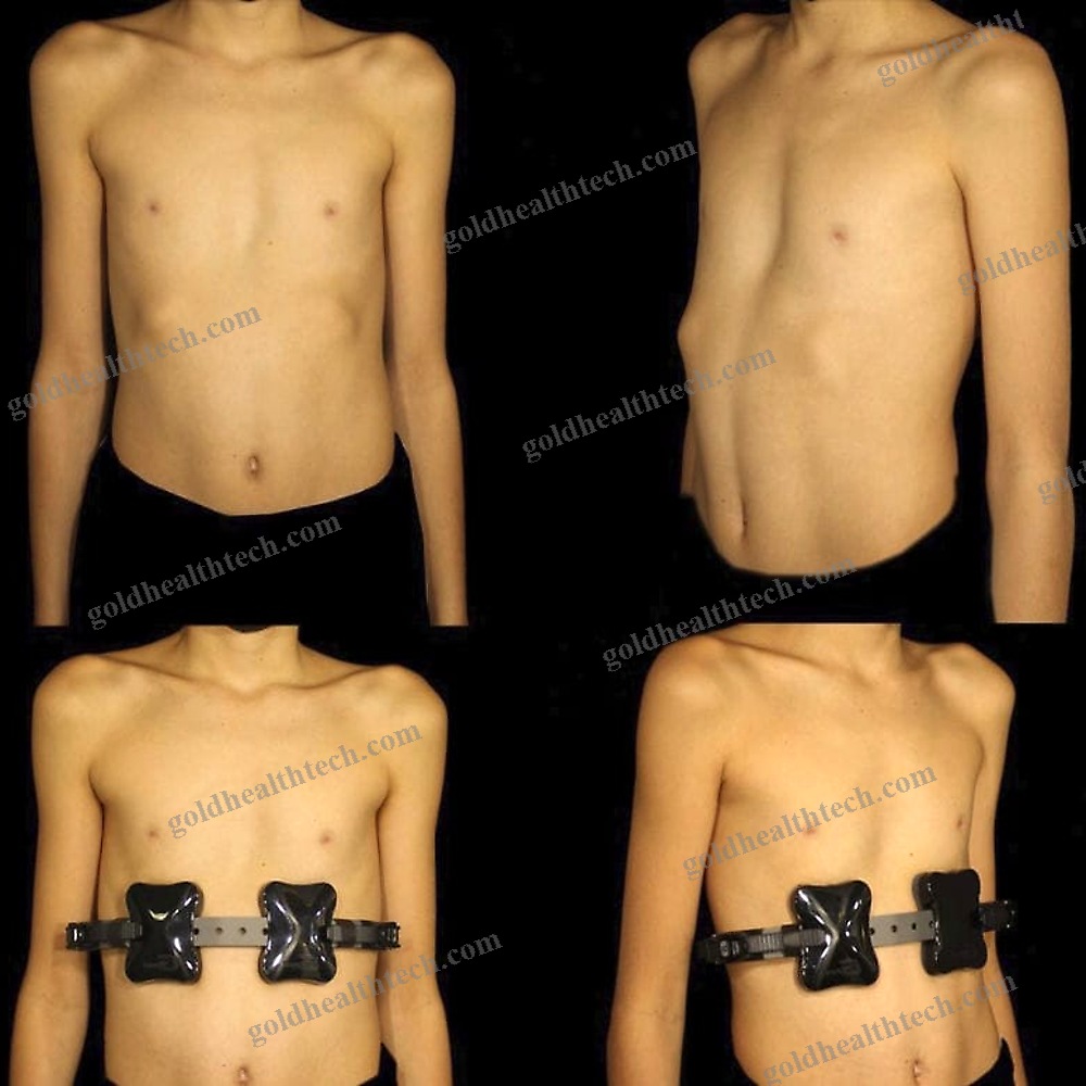 Posture-Correcting Orthosis