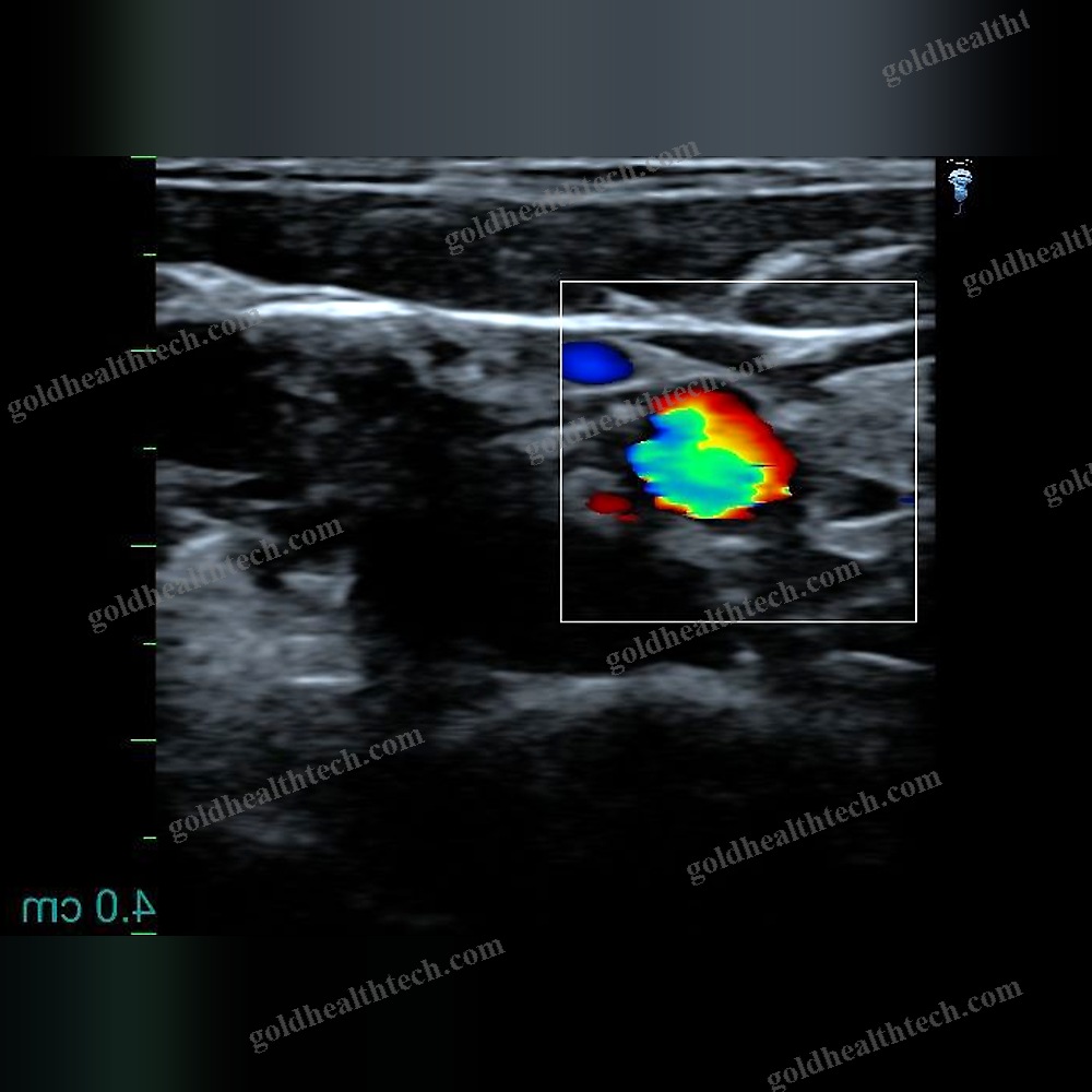 Hand-Held Ultrasound System
