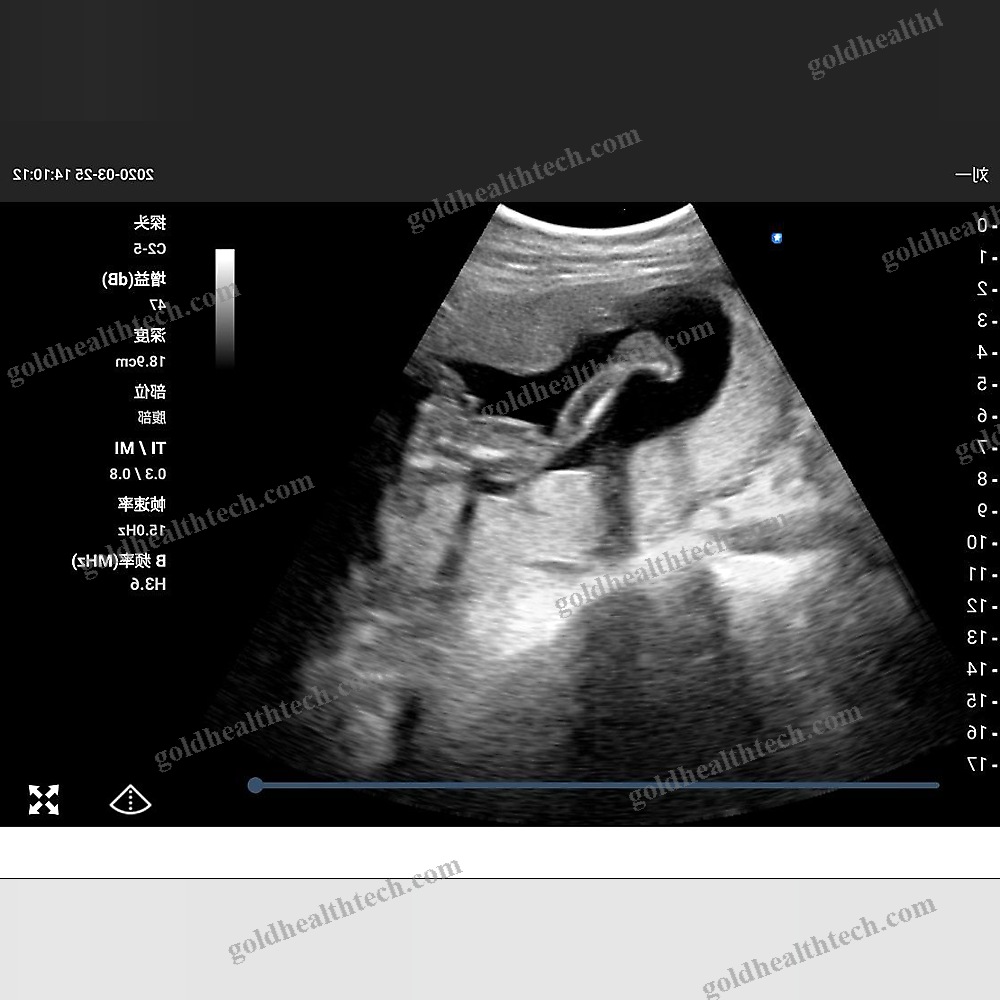 Hand-Held Ultrasound System