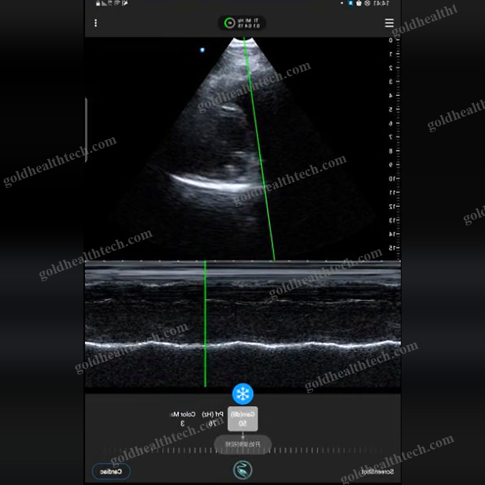 Hand-Held Ultrasound System
