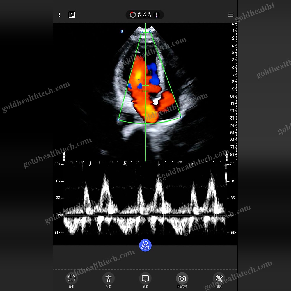 Hand-Held Ultrasound System
