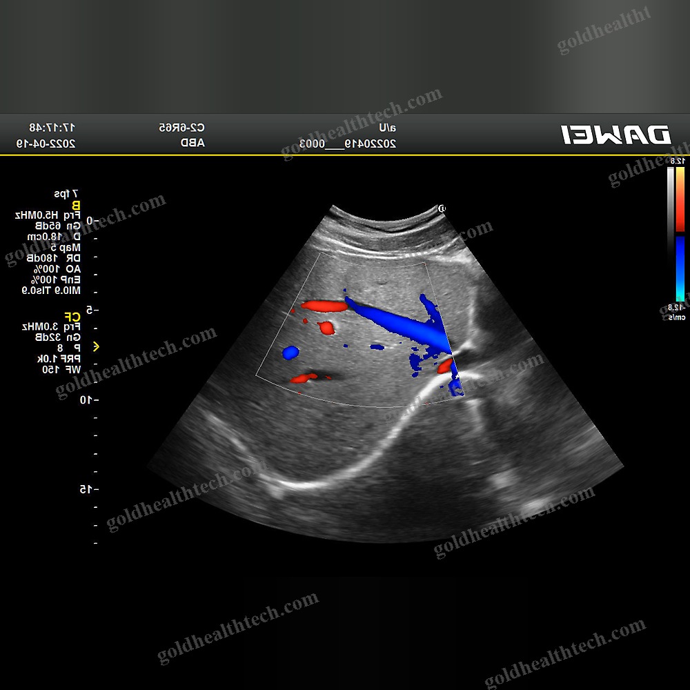 Color Doppler Ultrasound System