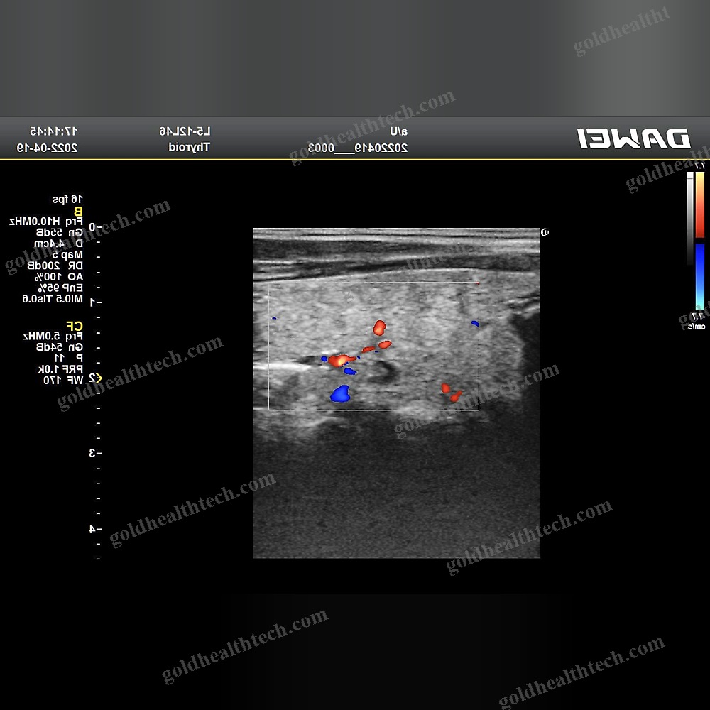 Color Doppler Ultrasound System
