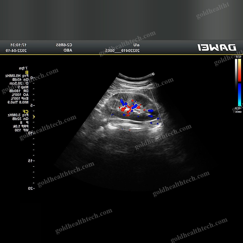 Color Doppler Ultrasound System