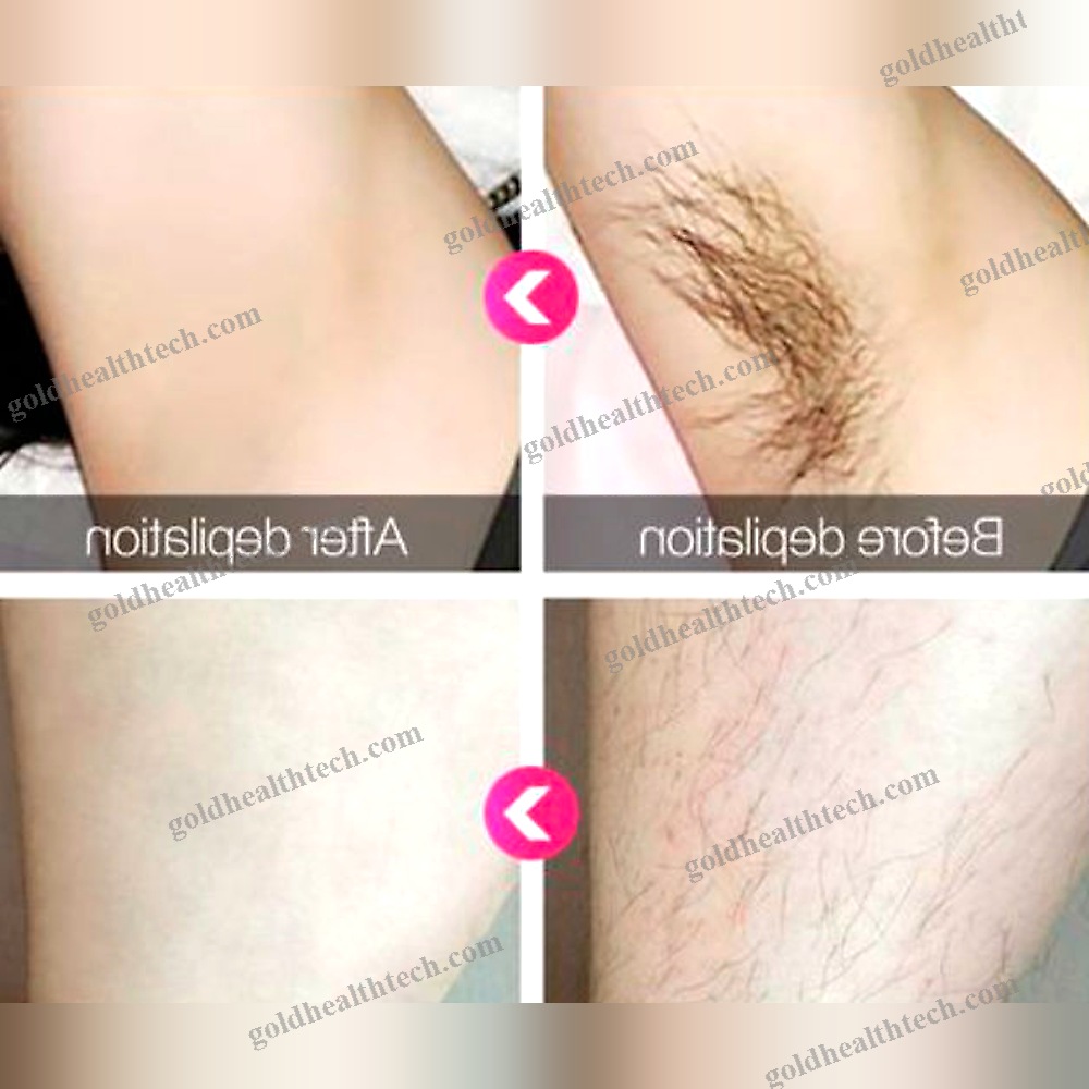 Pigmented Lesion Treatment Laser