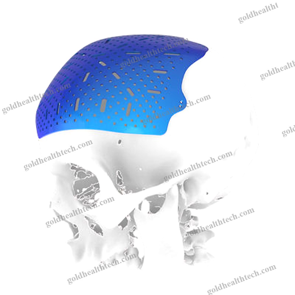 Custom-Made Cranial Implant
