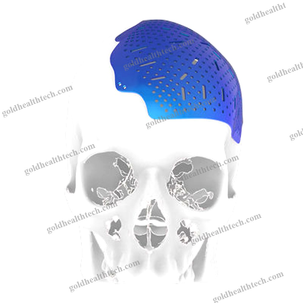 Custom-Made Cranial Implant