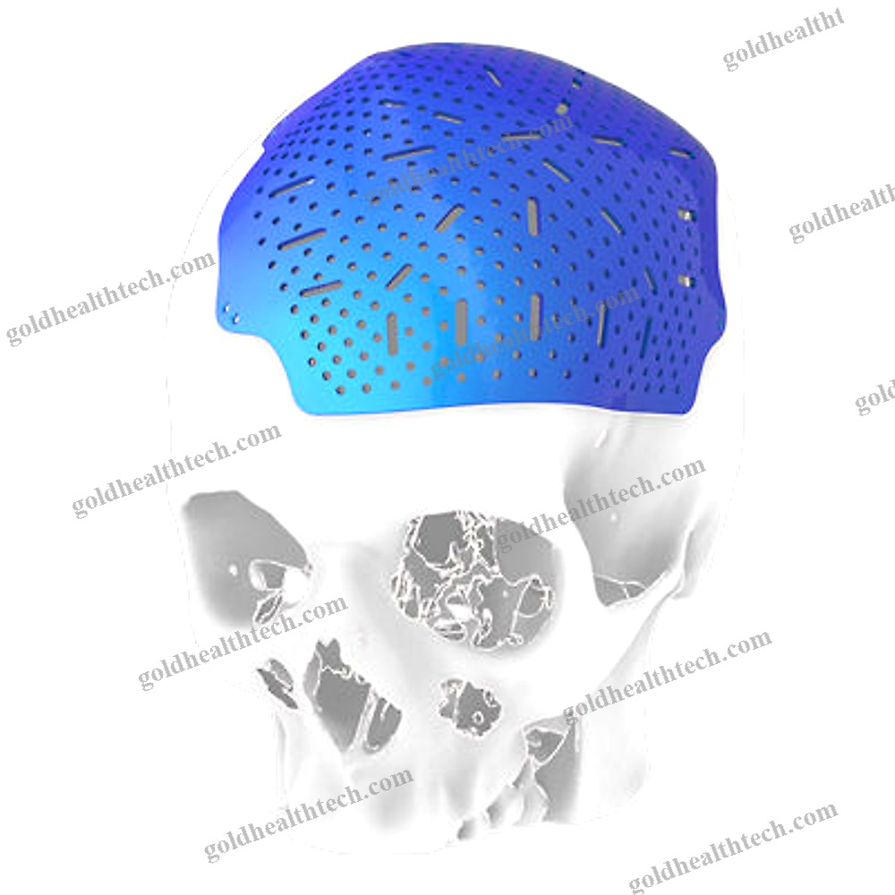 Custom-Made Cranial Implant