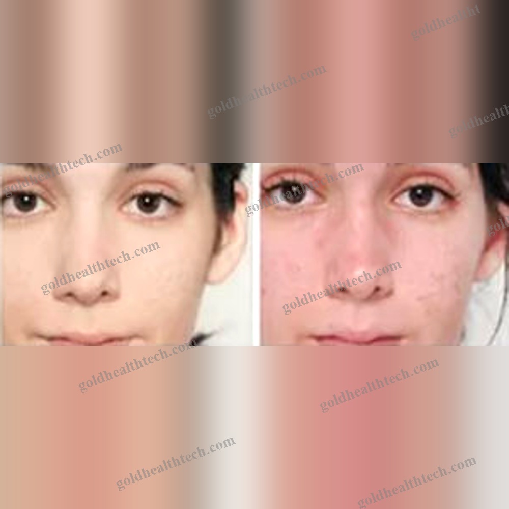 Skin Rejuvenation Phototherapy Lamp