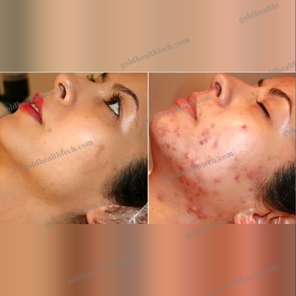 Skin Rejuvenation Phototherapy Lamp