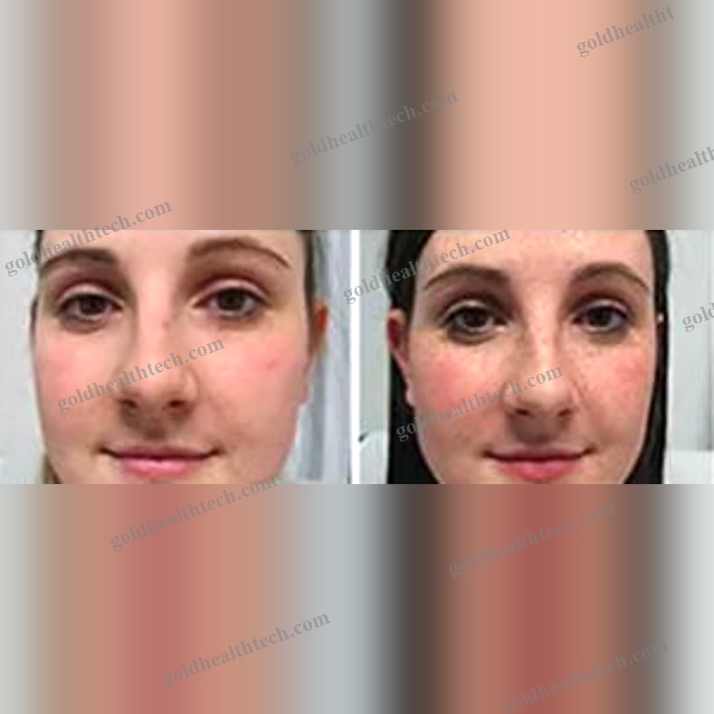 Skin Rejuvenation Phototherapy Lamp