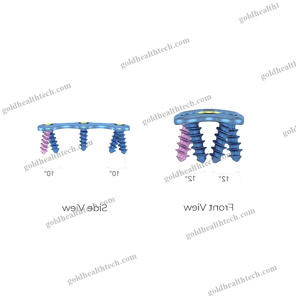 Cervical Arthrodesis Plate