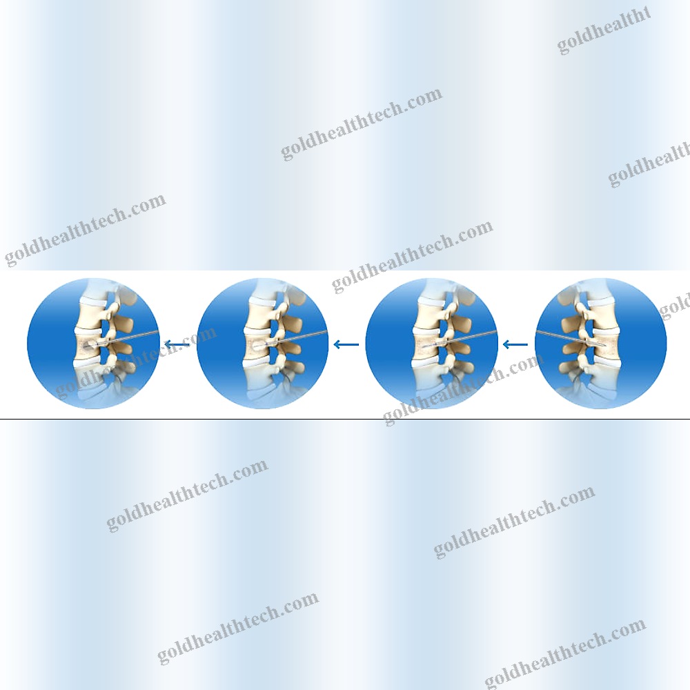 Percutaneous Kyphoplasty Instrument Kit