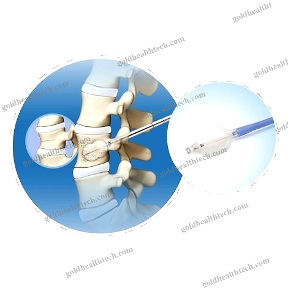 Percutaneous Kyphoplasty Instrument Kit