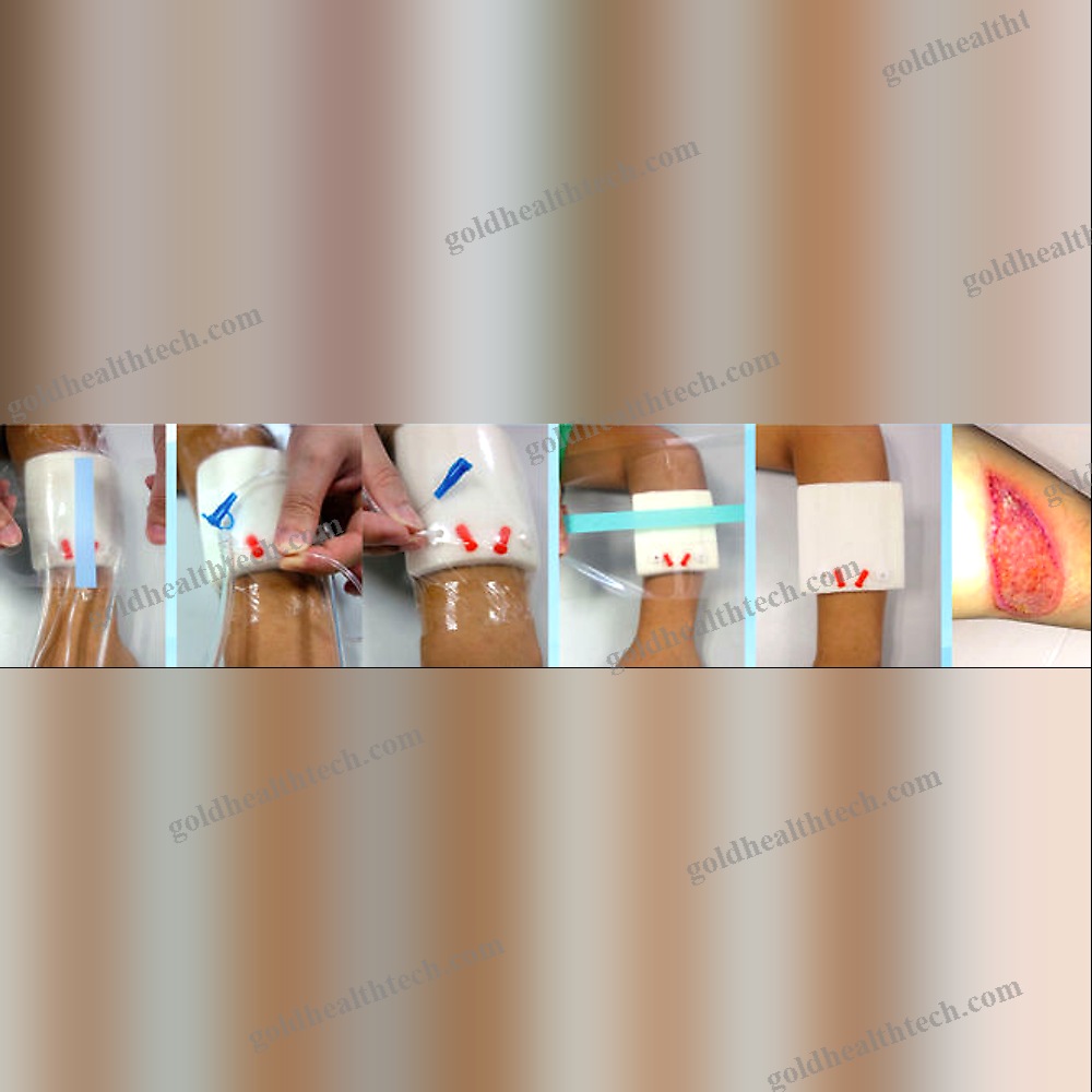 Manual Negative Pressure Wound Therapy Unit