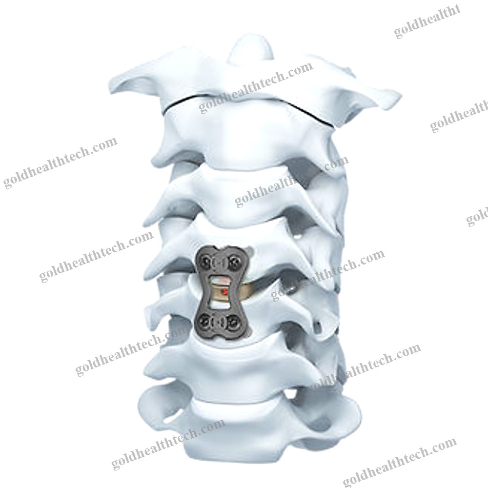 Cervical Arthrodesis Plate