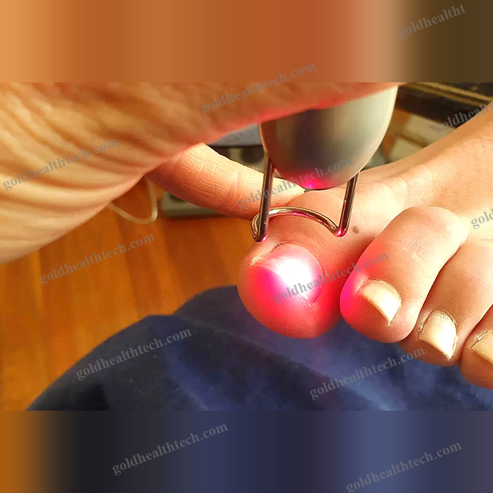 Podiatry Laser
