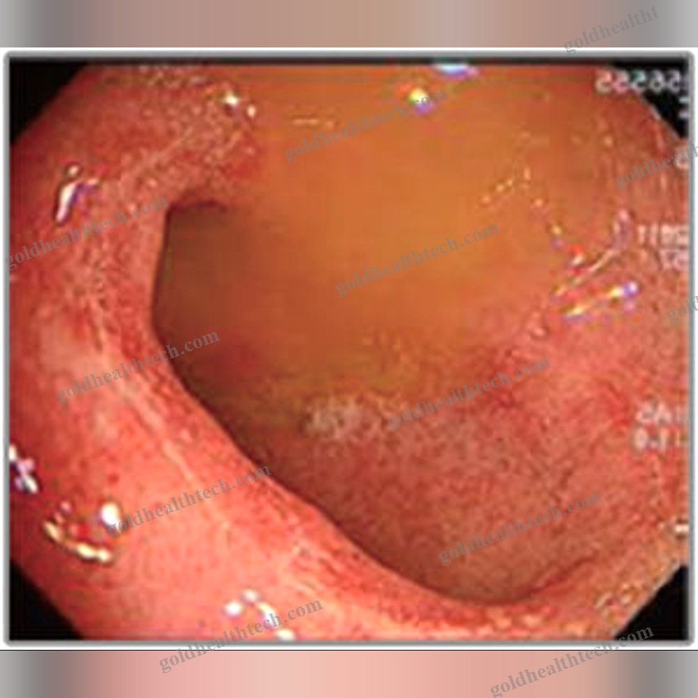 Video Gastroscope