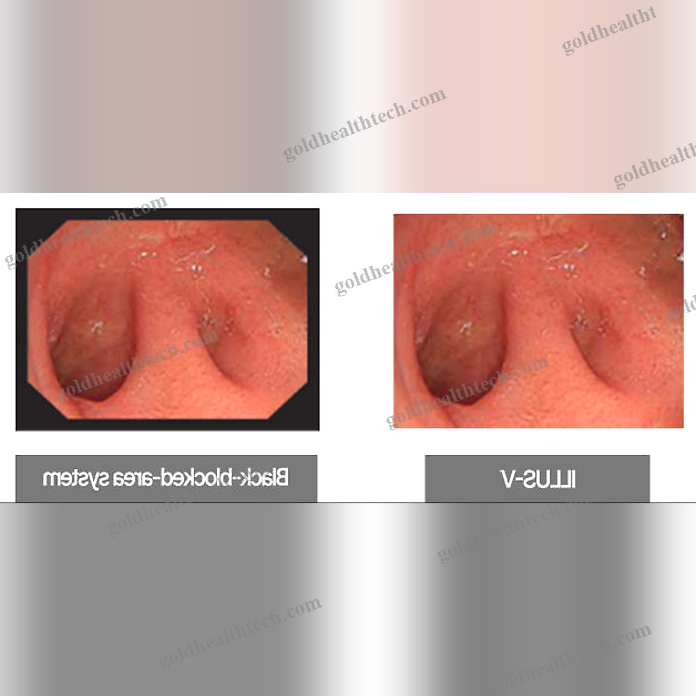 Video Gastroscope