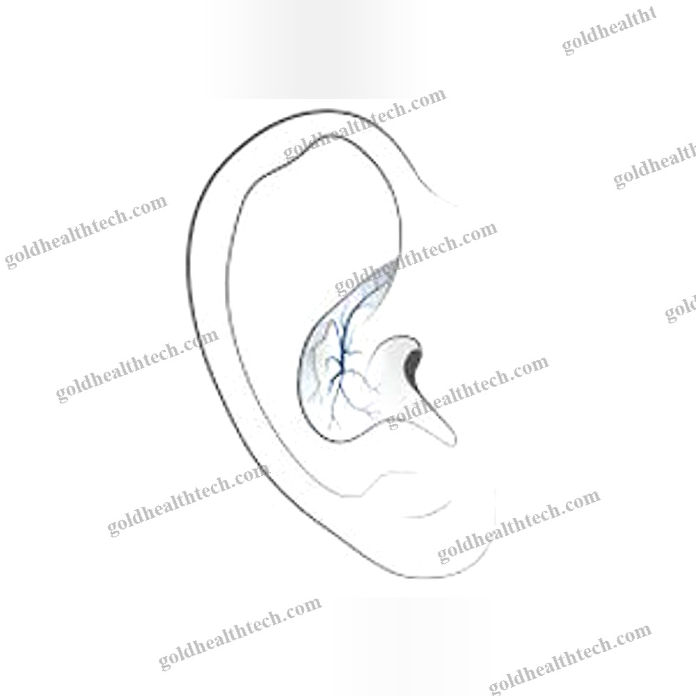 Transcutaneous Neurostimulator