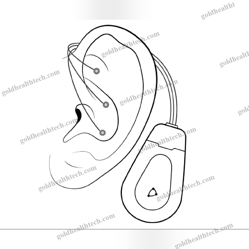 Transcutaneous Neurostimulator