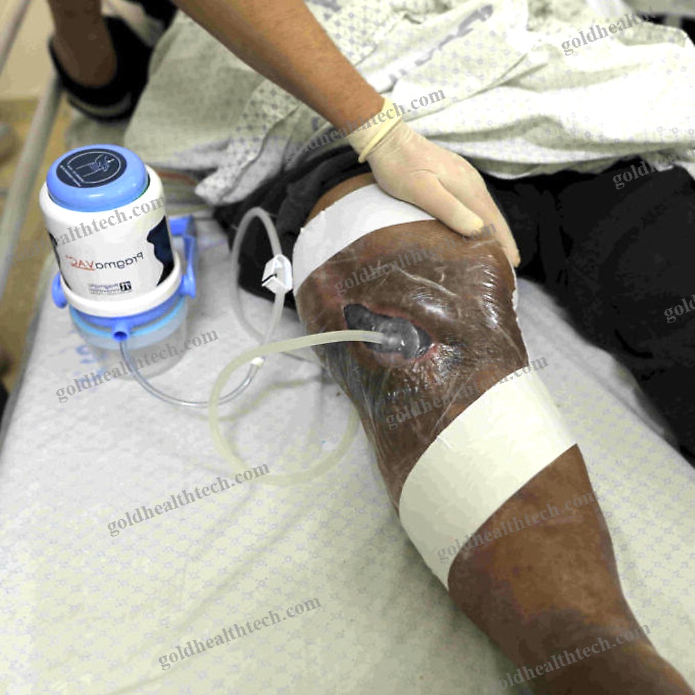 Manual Negative Pressure Wound Therapy Unit