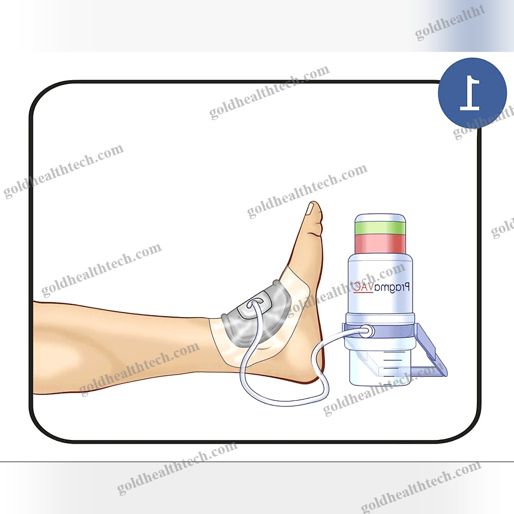 Manual Negative Pressure Wound Therapy Unit