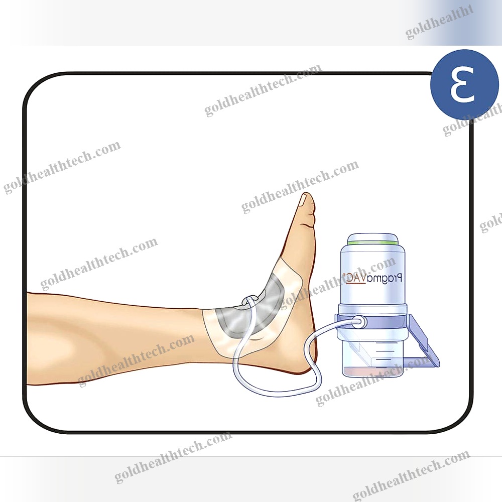 Manual Negative Pressure Wound Therapy Unit