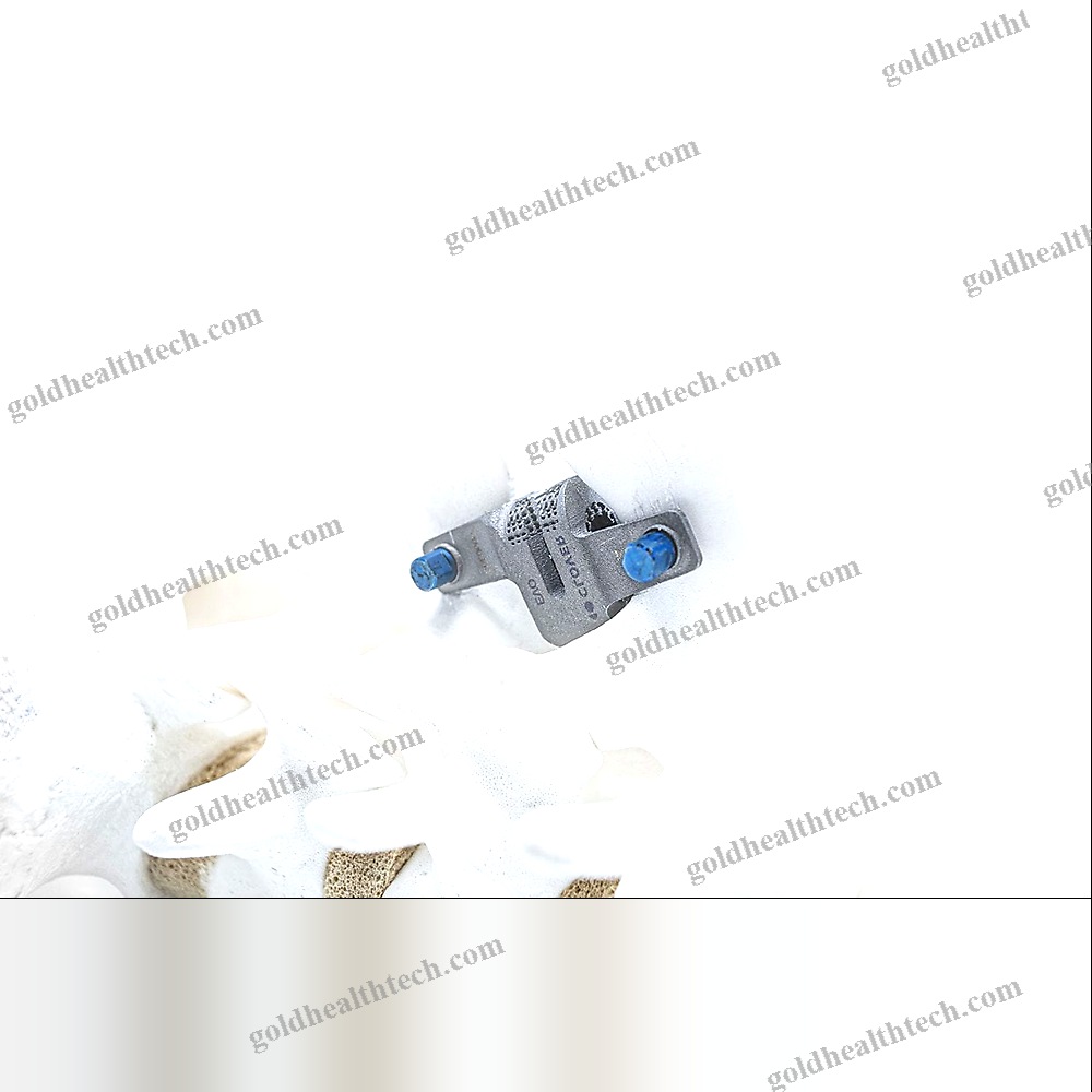 Lumbar Interspinous Vertebral Implant
