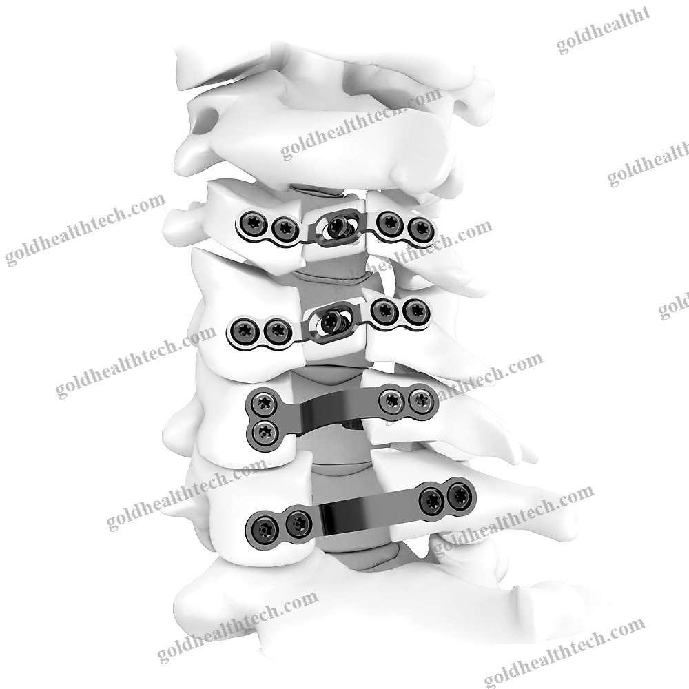 Cervical Vertebra Laminoplasty Plate