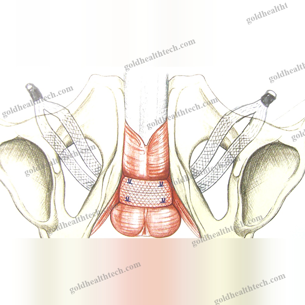 Urinary Incontinence Reconstruction Mesh