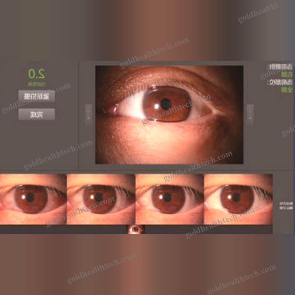 Meibography Dry Eye Diagnosis System