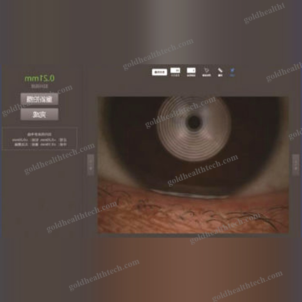 Meibography Dry Eye Diagnosis System