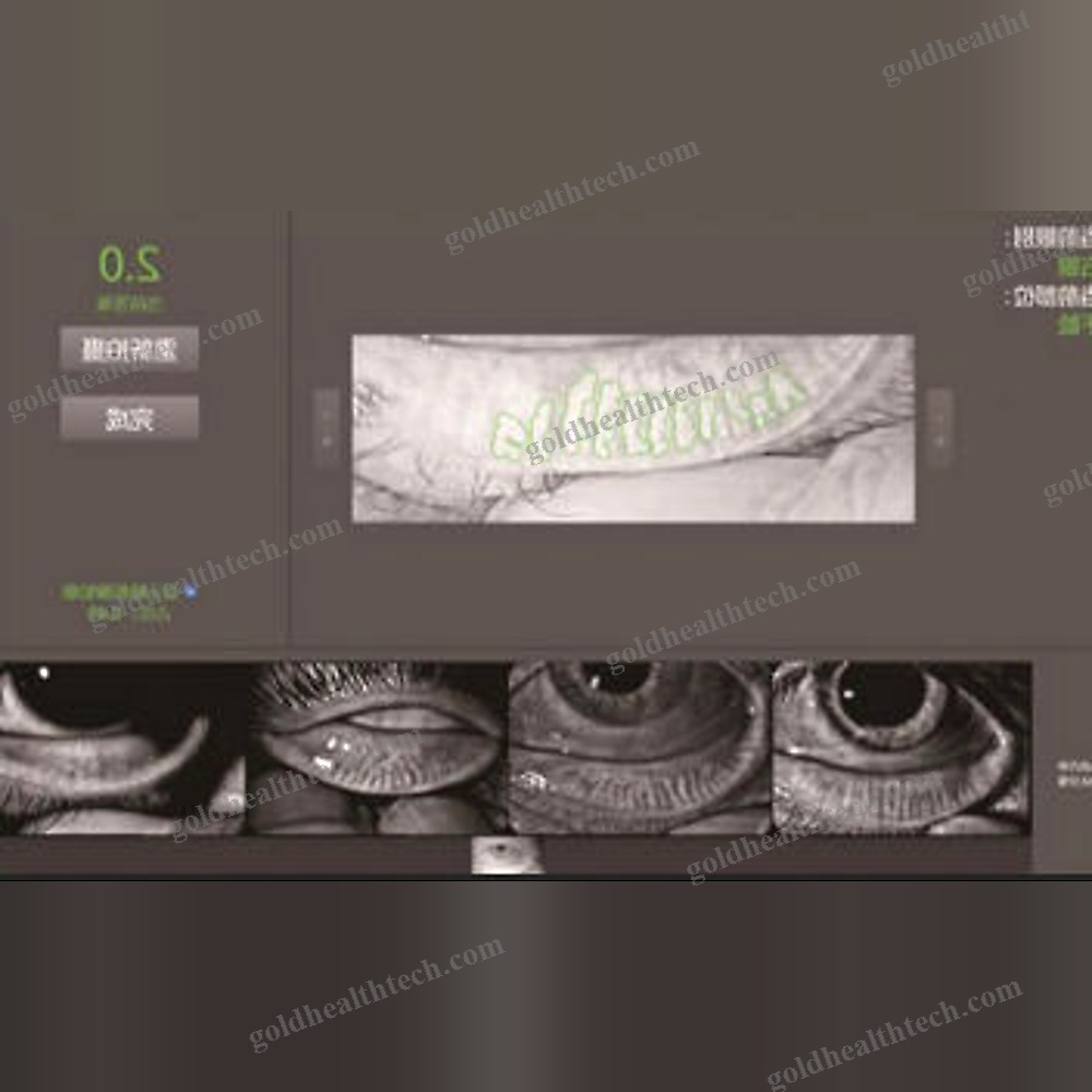 Meibography Dry Eye Diagnosis System