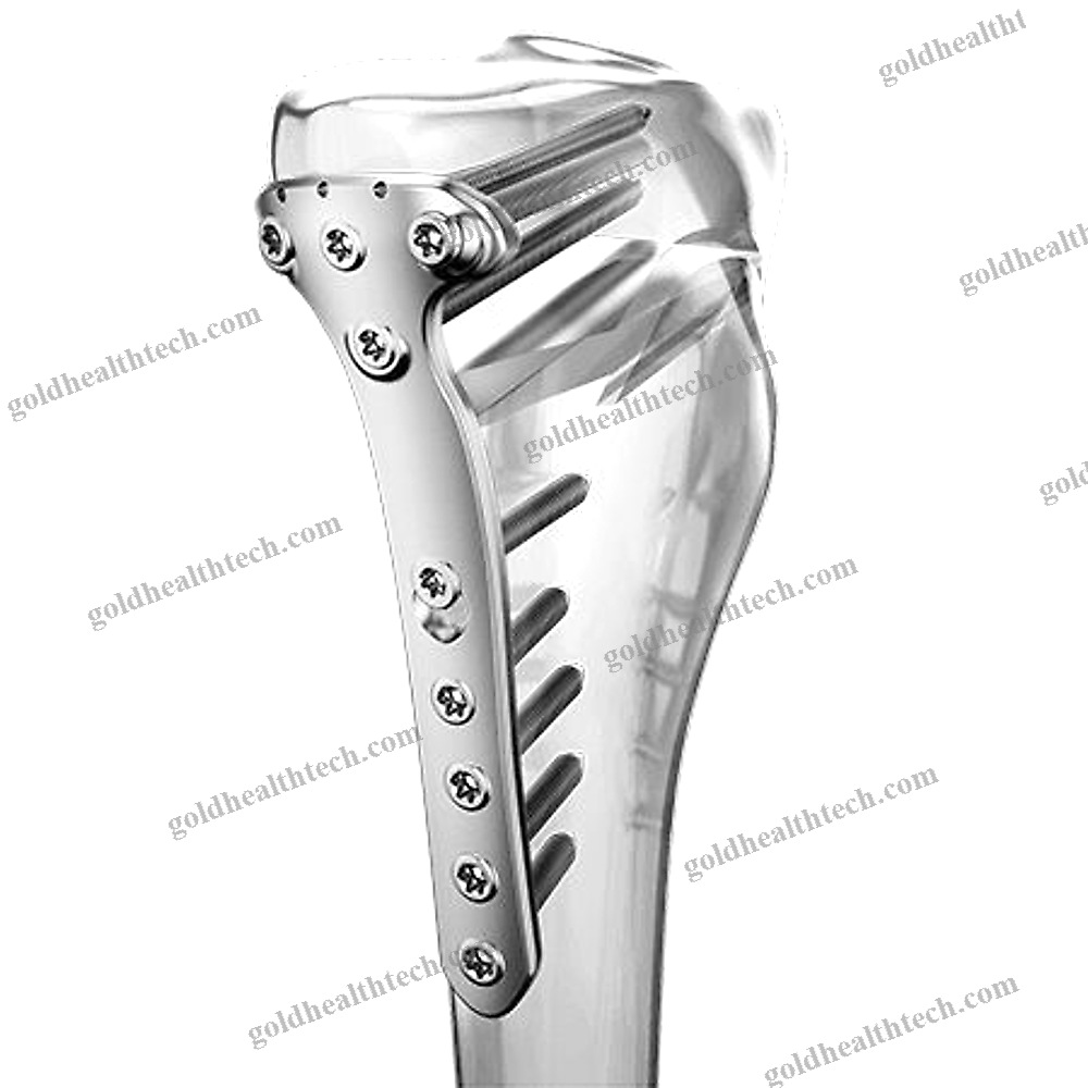 Tibia Osteotomy Plate