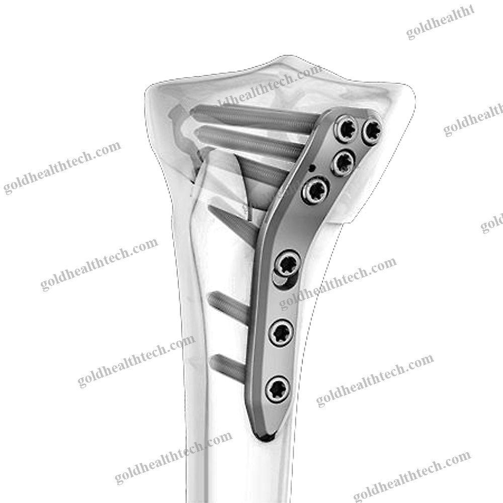 Tibia Osteotomy Plate