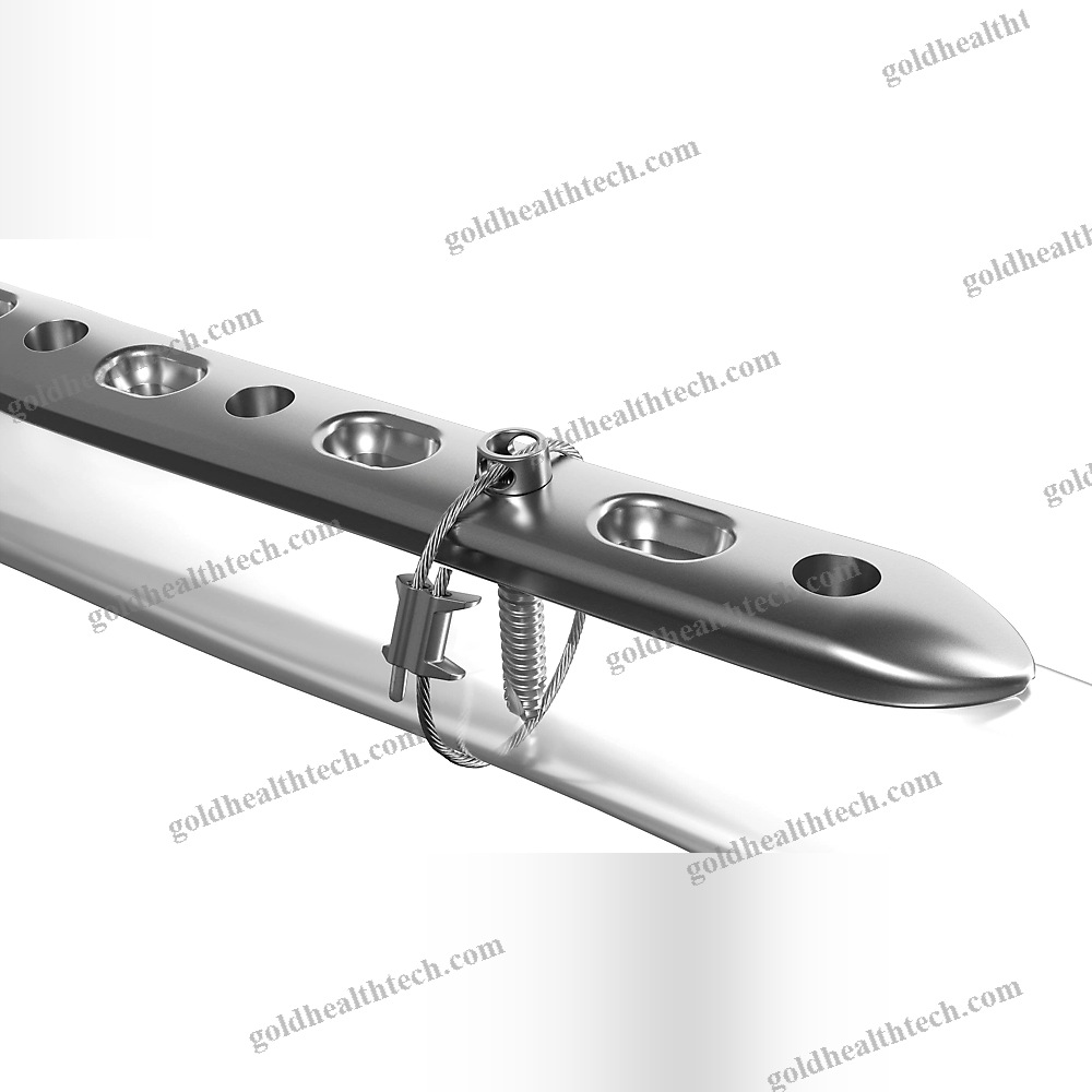 Hip Revision Surgery Bone Cerclage Wiring