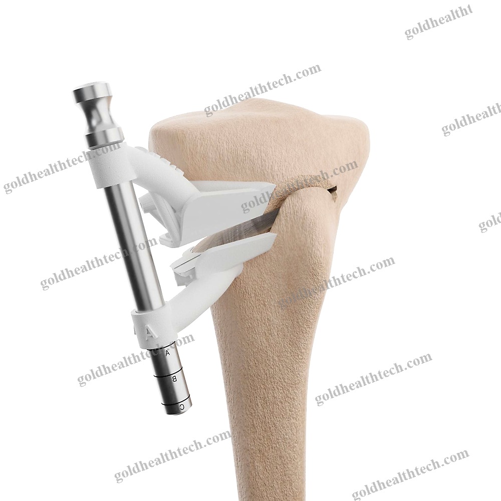 Tibial Osteotomy Resection Guide