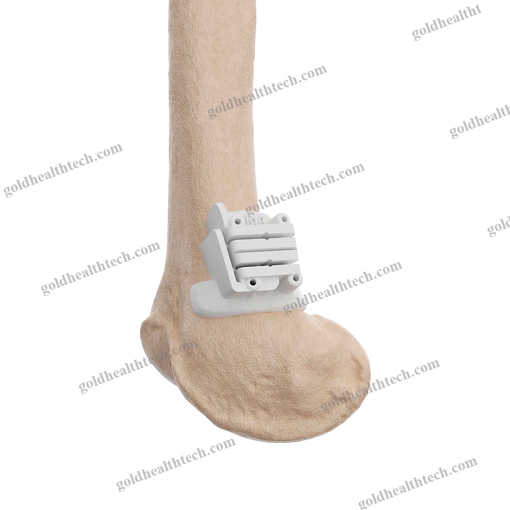 Tibial Osteotomy Resection Guide
