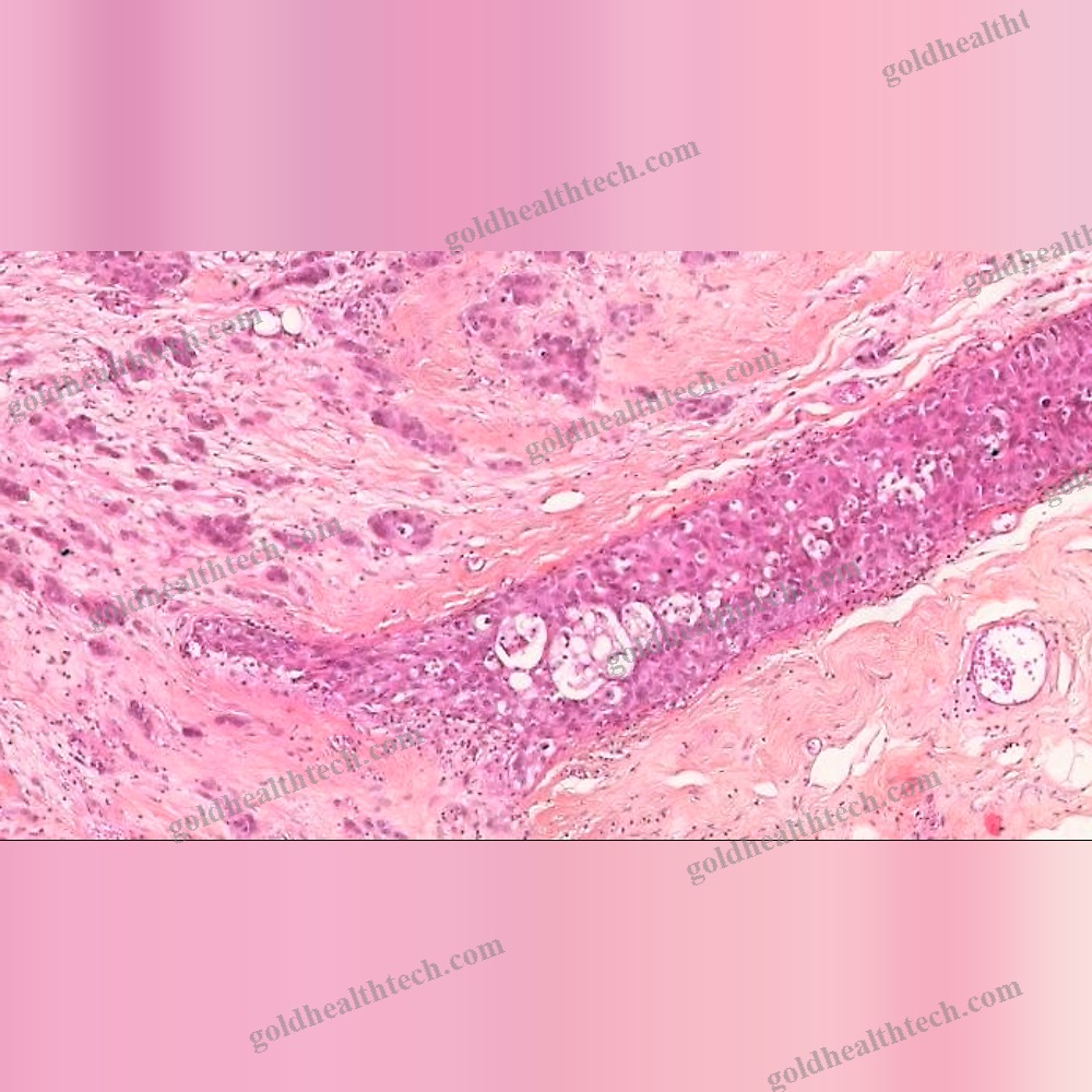 Breast Cancer Screening Ai Platform