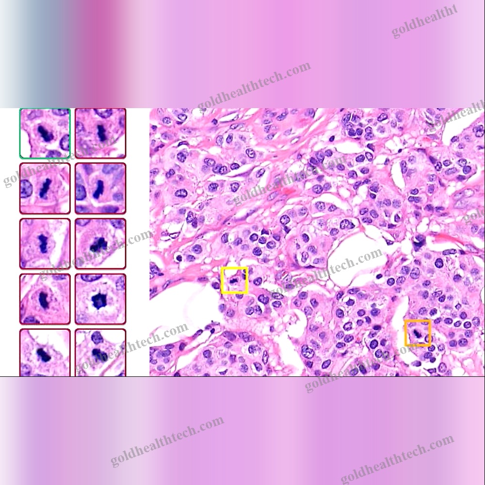 Breast Cancer Screening Ai Platform
