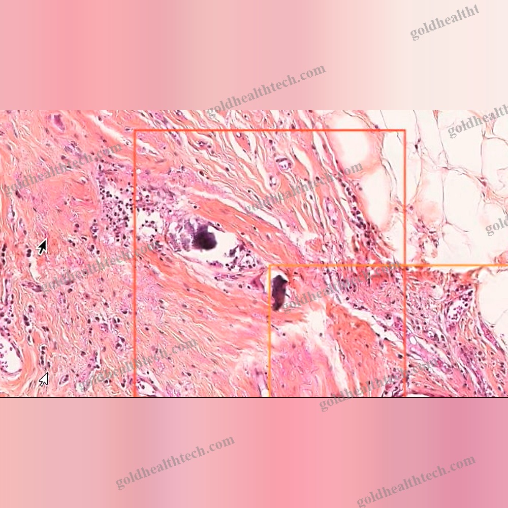 Breast Cancer Screening Ai Platform