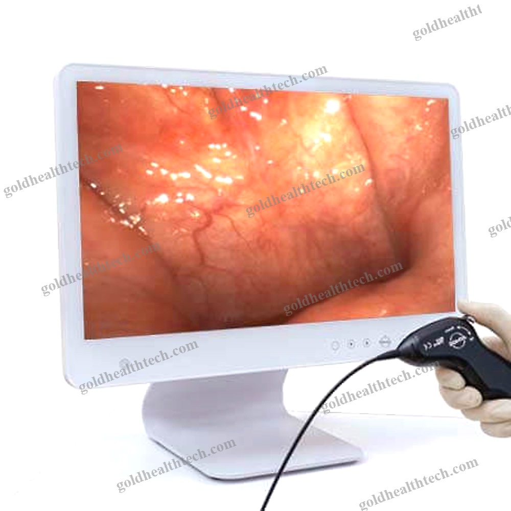 Wide-Angle Video Laryngoscope
